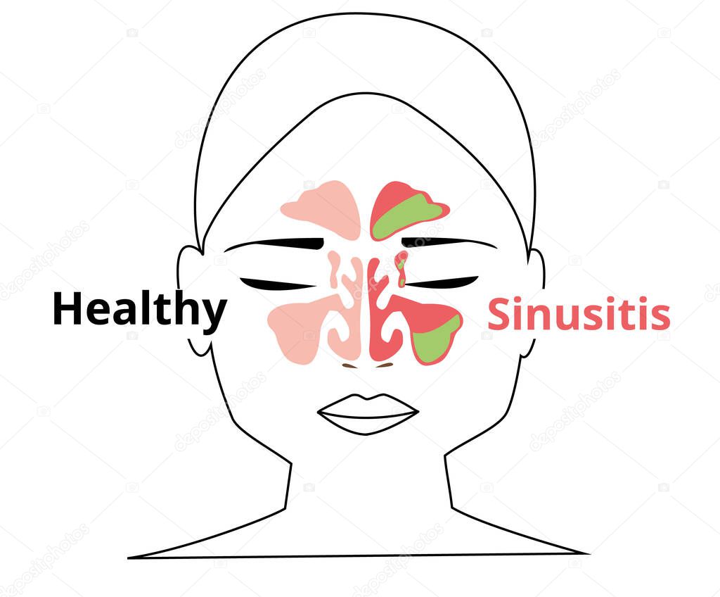 Sinusitis medical treatment. Healthy and inflammation sinus. Nasal diseases. Sinusitis, sinus infection diagnosis  medical infographic design. Otolaryngology concept. Isolated on white