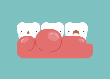 Gingivitis diş, diş kavramı çevresinde