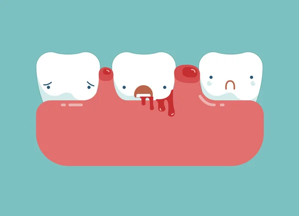 Гингивит и кровь, стоматологическая концепция — стоковый вектор