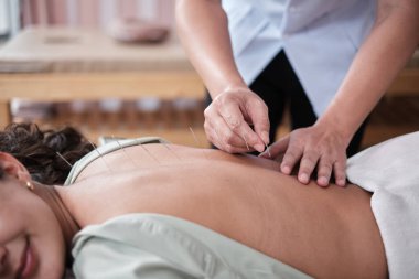 Asyalı fizyoterapistin elinin yakın çekimi, Latin kadın hastaya akupunktur tedavisi, kas ve sırt ağrısı giderici, hastane kliniğinde pasif tıbbi tedavi.