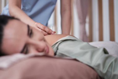 Asyalı fizyoterapistin elinin yakın çekimi, Latin kadın hastaya akupunktur tedavisi, kas ve sırt ağrısı giderici, hastane kliniğinde pasif tıbbi tedavi.