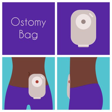 Ostomy bag vector illustration flat design clipart