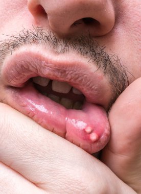 Painful aphtha ulcer on man's mouth. clipart