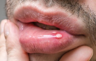 Painful aphtha ulcer on man's mouth. clipart