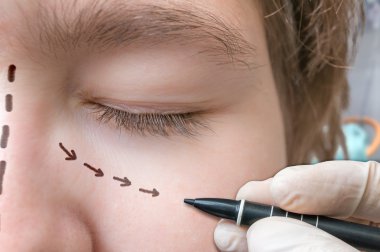 Yüz plastik cerrahi. El göz çevresinde marker ile çizgi çizme