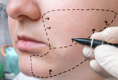 Facial plastic surgery. Hand is drawing lines with marker on cheek clipart