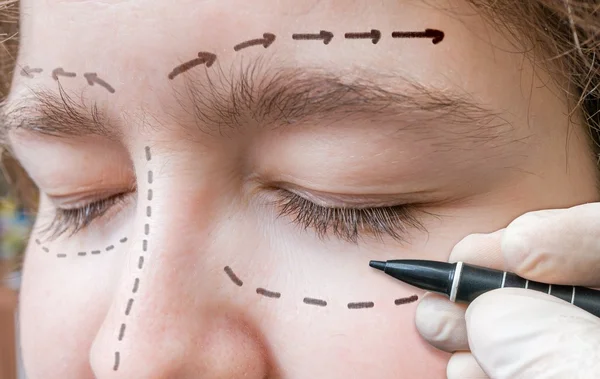 Chirurgie plastique faciale. La main dessine des lignes avec un marqueur autour de l'œil — Photo