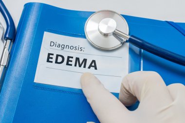Edema - lymphatic diagnosis on blue folder with stethoscope. clipart