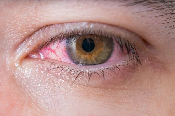 Macro de conjuntivitis ojo rojo . — Foto de Stock