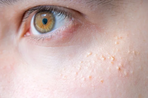 Milia (milium) - Pickel rund um das Auge auf der Haut. — Stockfoto