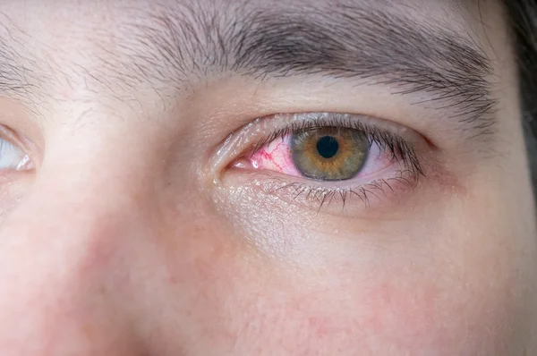 Homem com olho vermelho ferido . — Fotografia de Stock
