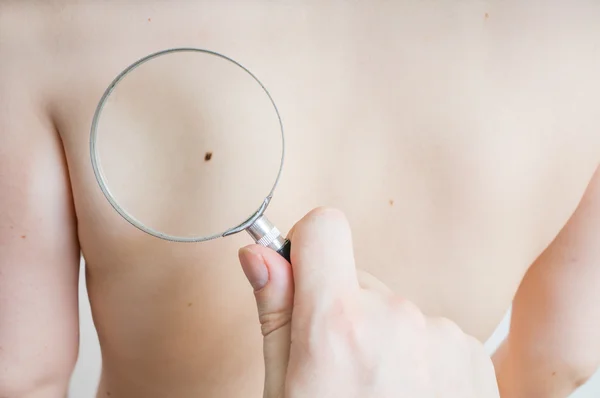 Doctor holds magnifying glass in hand and is examining patient skin for melanoma suspicion. — Stock Photo, Image