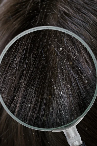 Exemplo de flocos de caspa branca no cabelo com lupa . — Fotografia de Stock