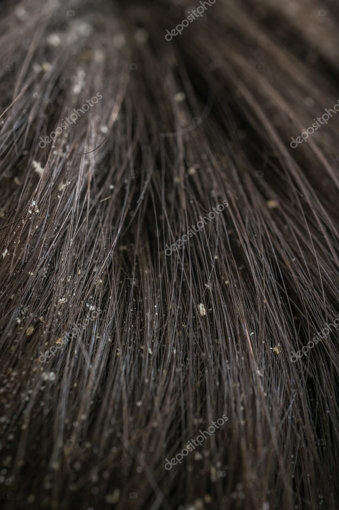 Why do lice in hair look like Why do lice in hair look like