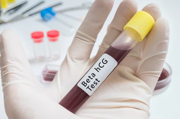 Reagenzglas mit Blut für Beta-HCG-Test in der Hand. — Stockfoto