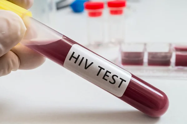 Test HIV - provetta con sangue in laboratorio . — Foto Stock