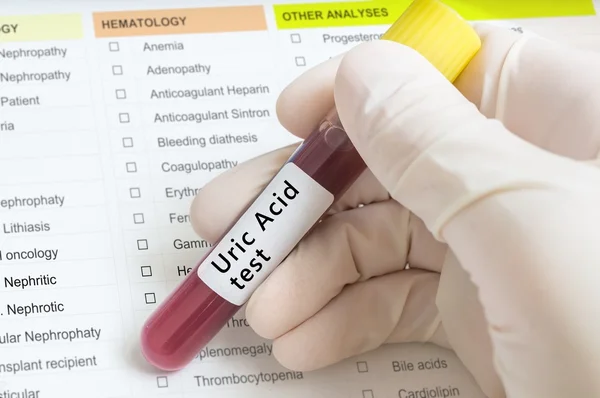 Hand holds test tube with blood for Uric Acid Test. — Stock Photo, Image