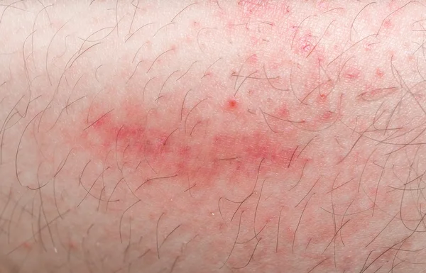 Красный прилив на кожу ног . — стоковое фото