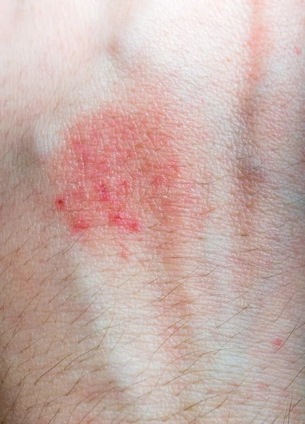 Pressão vermelha ou eczema na mão de paciente alérgico . — Fotografia de Stock