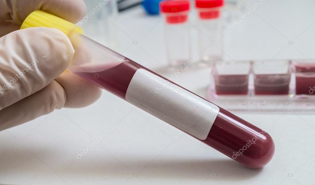 https://st2.depositphotos.com/2924751/9945/i/950/depositphotos_99456024-stock-photo-blood-in-test-tube-researcher.jpg