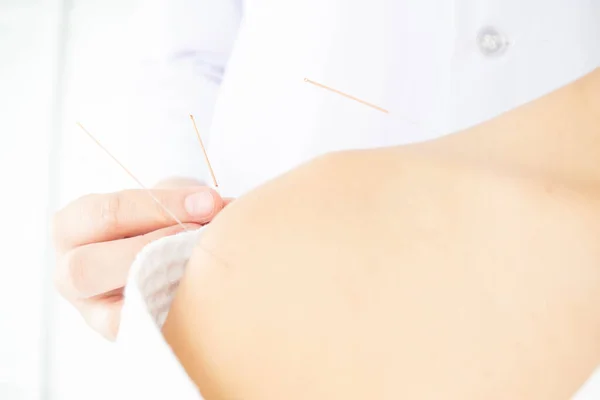 Close up of hands doing acupuncture with at patient shoulder