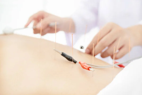 Electroacupuncture fertility treatment - Stock Image - C022/3257 - Science  Photo Library