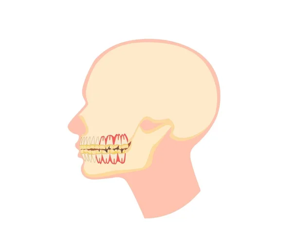 Inflamed tooth gums illustration. Human head with red infectious paradanthosis caries decay of tooth enamel. — Stock Vector