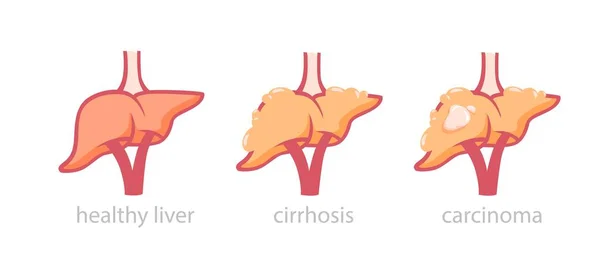 Gezonde lever en tumor beschadigde illustratie. Proces transformatie normaal orgaan in vette hepatose en cirrose. — Stockvector