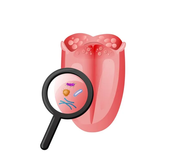 Examen de la lengua infección e ilustración de bacterias. Lupa estudio inflamación tejido rojo y alteraciones del gusto. — Vector de stock