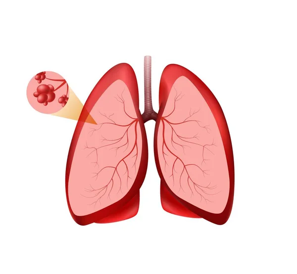 Розташування легеневої альвеоли. Рожеві легені з червоними судинами та здорові бронхіальні пухирці добре дихають . — стоковий вектор