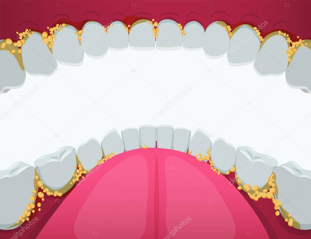 Oral cavity with tartar clipart. Yellow problematic plaque and developing dental caries sore swollen gums.