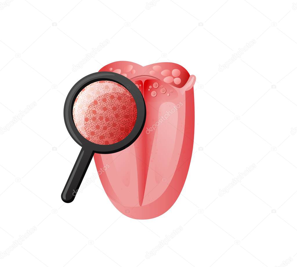 Inspection taste receptors on tongue illustration. Examination of mucous tissues under magnifying glass for presence candida.