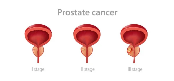前列腺癌的分期。男性腺体发育为恶性肿瘤、生殖功能受损的破坏. — 图库矢量图片