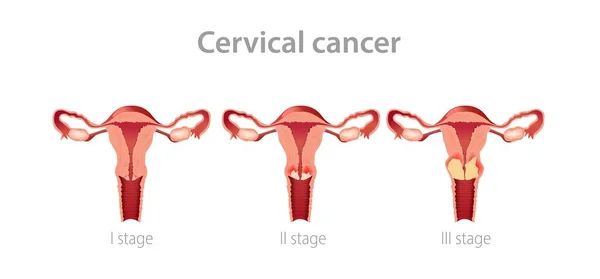 Cervical cancer stages illustration. Development gynegological tumor in female vagina with subsequent growth of oncology.