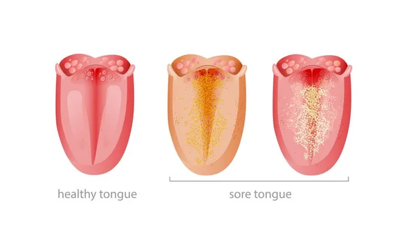 Zdrowy i chory język. Różowy czysty organ i dotknięte żółtą płytkę zakaźną i bakteryjne grzyby. — Wektor stockowy