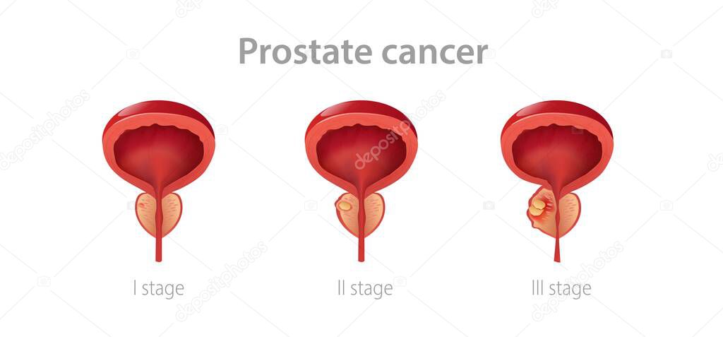 Stages prostate cancer. Disruption of male gland with its growth into malignant tumor impaired reproductive function.
