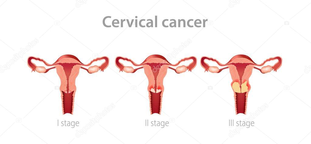 Cervical cancer stages illustration. Development gynegological tumor in female vagina with subsequent growth of oncology.