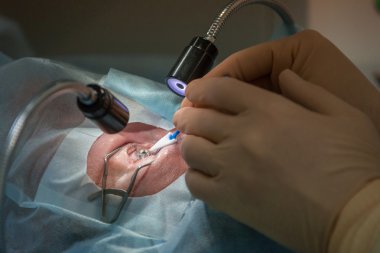 Lasik Oftalmoloji işlemi