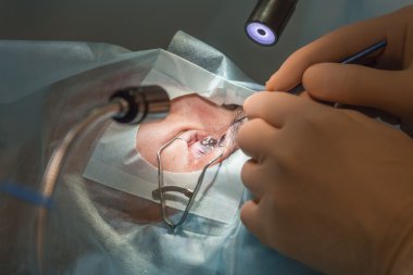 Flap raising during lasik operation. (one of 7 shots)