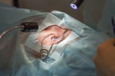 Flap raising during lasik operation. (one of 7 shots)