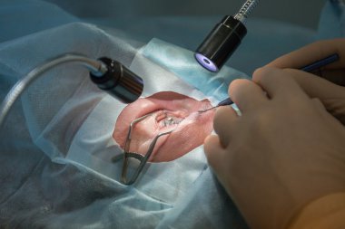 Lasik Oftalmoloji işlemi