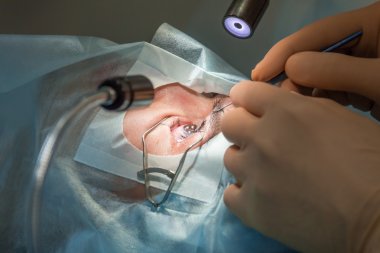 Flap raising during lasik operation. (one of 7 shots)