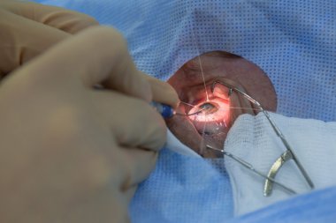 Using Iris retractors during ophtalmology operation.