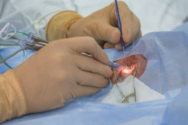 Using Iris retractors during ophtalmology operation.