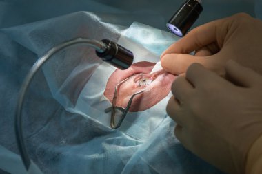 Flap raising during lasik operation.