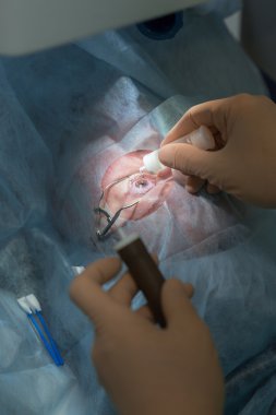 Lasik Oftalmoloji işlemi