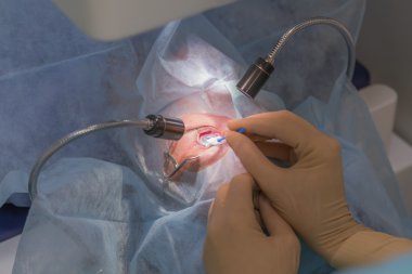 Lasik Oftalmoloji işlemi