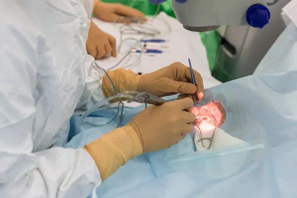 Bimanual cataract extraction — 스톡 사진