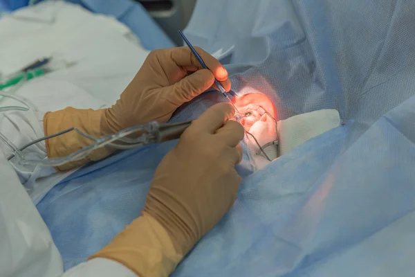 Bimanual cataract extraction — Stok fotoğraf