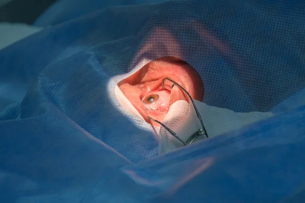 Using Iris retractors during ophtalmology operation. — Stock Fotó